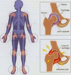 Osteoarthritis