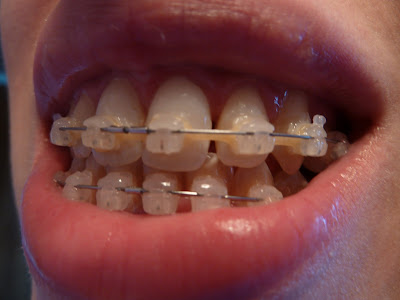 A photo of my teeth with the big new gaps almost closed