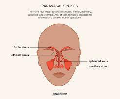 सायनस क्या है, सायनस के कारण, प्रकार,  घरेलू उपाय और सावधानीया। What is sinusitis in hindi.
