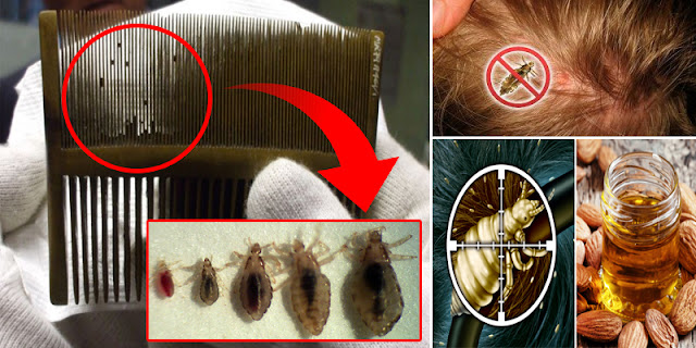 How To Remove Nits Of Lice Within 10 Minutes By Using The Method