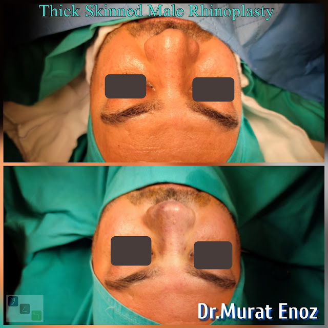 Male Rhinoplasty Operation For Thick Skinned Nose - Oily thick skinned nose job - Nose job for men Turkey