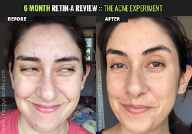 0.05% Tretinoin Cream Before/After :: The Acne Experiment