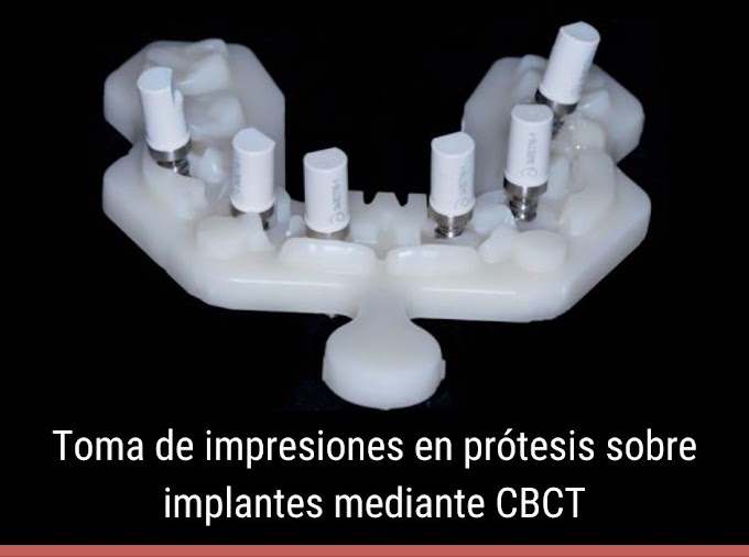 PDF: Toma de impresiones en prótesis sobre implantes mediante CBCT