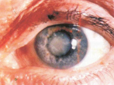 Pengertian Tentang Penyakit Mata Katarak