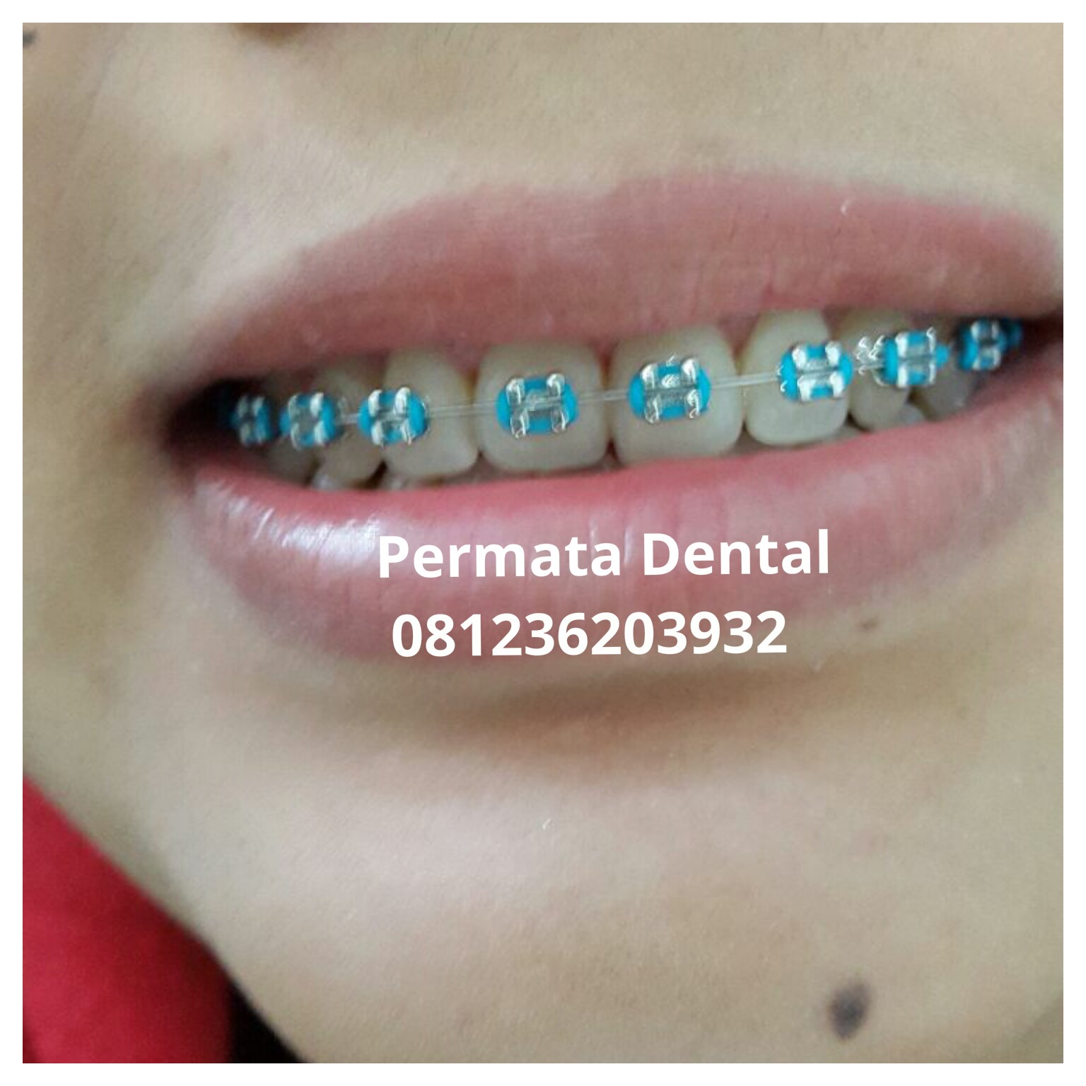 Klinik Gigi Jember Permata Dental Behel  Bracket 