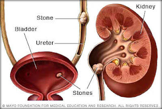 siruneer paadhai kal, siruneer kuzhai, anatomy, vazhi adaippu, block in kidney, urinary track pain, pain in kidney damage