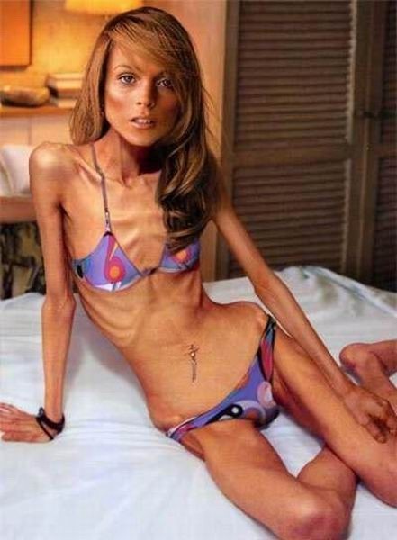 A triste e falsa beleza da anorexia - Parte 3