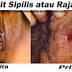 Obat Alami Sipilis Pada Pria