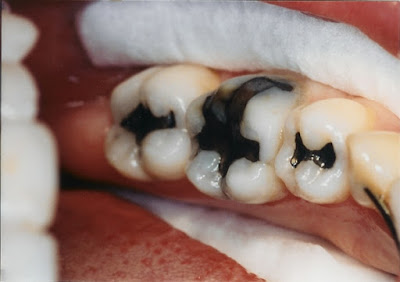 Răng bị sâu nặng có điều trị được không? 1