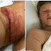 Teen Nearly Decapitated After Cord Headphones Sliced Through His Neck