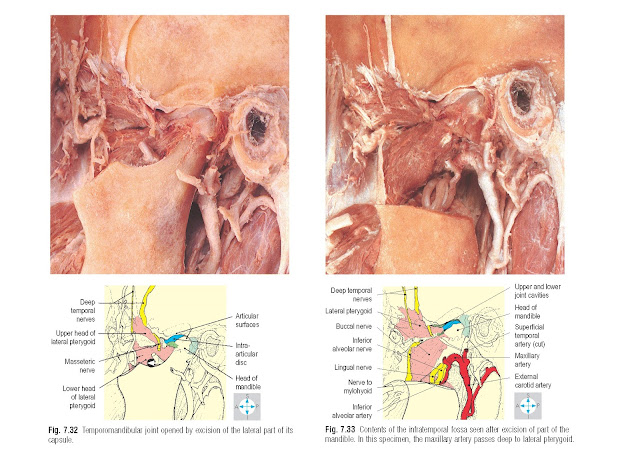 Contents of the infratemporal fossa seen after excision of part of the mandible. In this specimen, the maxillary artery passes deep to lateral pterygoid.