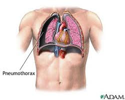 tension pneumothorax, spontaneous pneumothorax, spontaneous, pneumothorax symptoms, pneumothorax treatment , open pneumothorax, pneumothorax symptoms, atelectasis, symptoms of pneumothorax, pneumothorax definition, right pneumothorax, pneumothorax causes, pneumothorax, what is pneumothorax, Hemopneumothrax