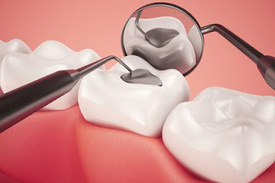 Quy trình trám răng bị sâu nặng an toàn 1