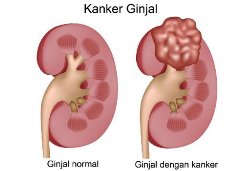 Ginjal normal dan ginjal dengan kanker