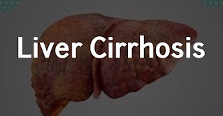 Liver cirrhosis