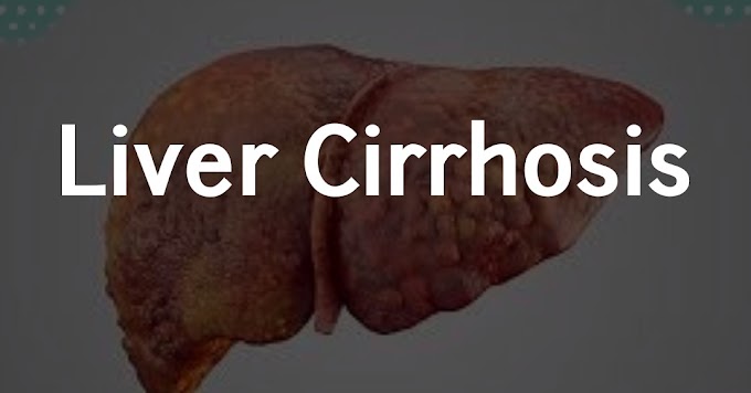 Liver cirrhosis:causes , symptoms and treatment of cirrhosis of liver