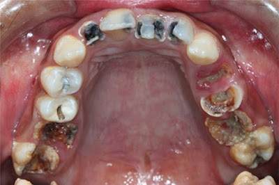 Răng cấm bị sâu và cách điều trị hiệu quả?