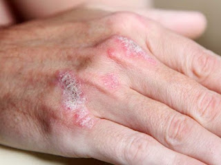 Hasil gambar untuk eksim atau dermatitis