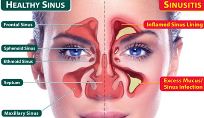 Sinusitis