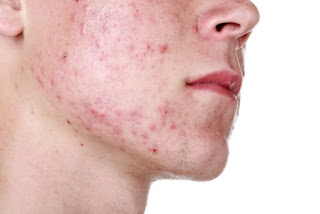 https://natwiki.blogspot.com/2018/01/7-consejos-para-tratar-el-acne.html