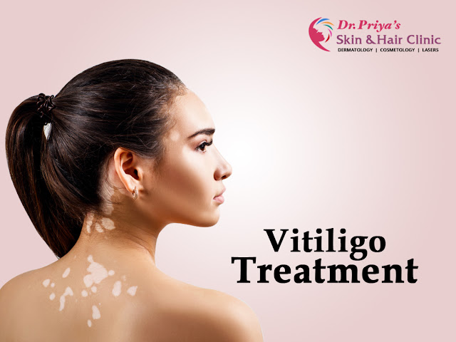 Best Vitiligo Treatment in Bangalore