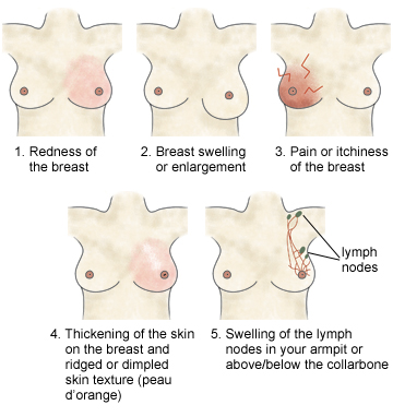 Symptoms of Brest Mastitis