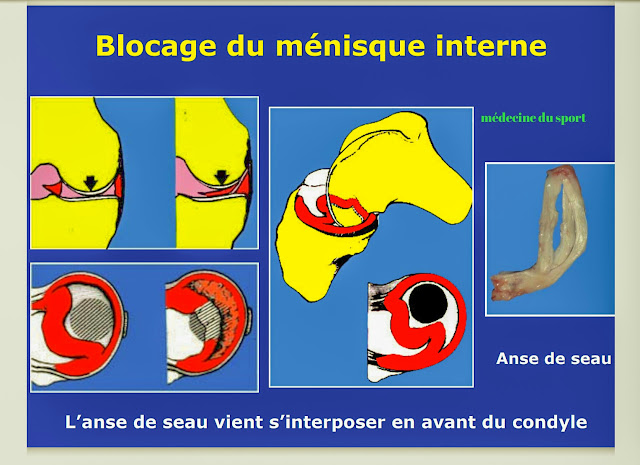 Pathologies des ménisques