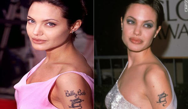 New tattoo removal technology for celebrities