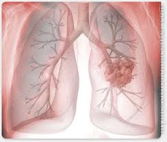  asbestosis asbestosis symptoms cancer diagnosis fibers lung cancer