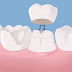 Phương pháp điều trị răng bị mẻ hiệu quả
