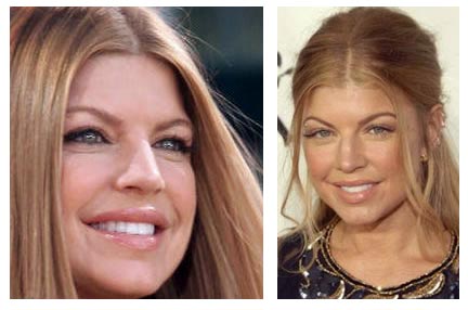 Fergie Before Plastic Surgery