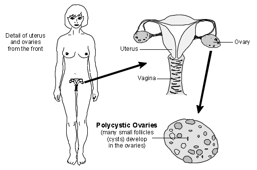 Polycystic Ovary syndrome