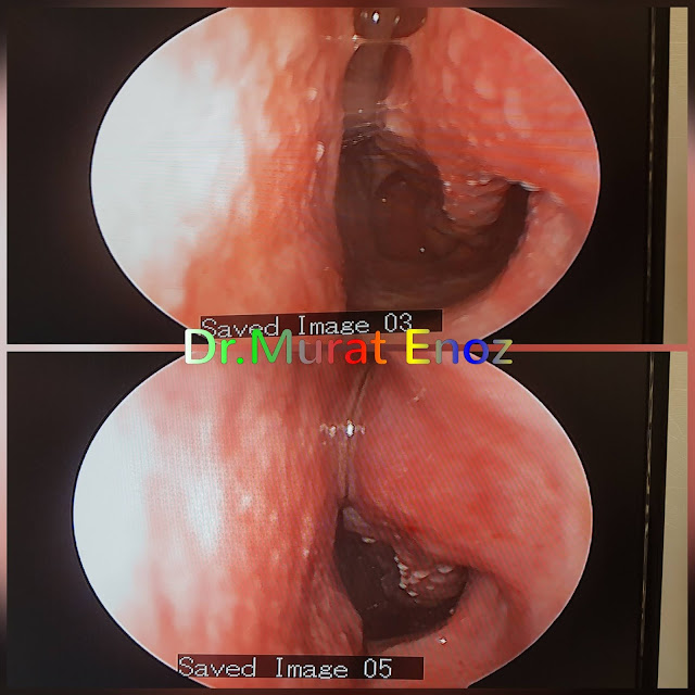 Boş burun sendromu tedavisinde Hyaluronik Asit dolgusu - Burun eti dolgusu - Treatment of Empty nose syndrome with hyaluronic acid filler - Boş burun - Geniş burun boşluğu sendromu - Burun eti büyütülmesi - Empty Nose Syndrome (ENS) - Hyaluronic acid gel in the treatment of empty nose syndrome - Empty Nose Syndrome - Treatment of Empty Nose Syndrome - Treatment of Empty Nose Syndrome in Istanbul