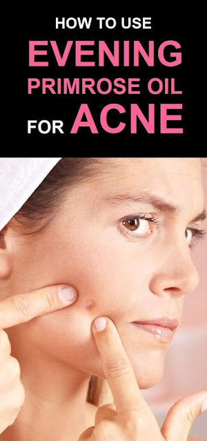 How to Get Rid of Acne Fast with Evening Primrose Oil