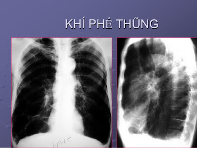 Khí phế thũng là gì, triệu chứng và cách điều trị