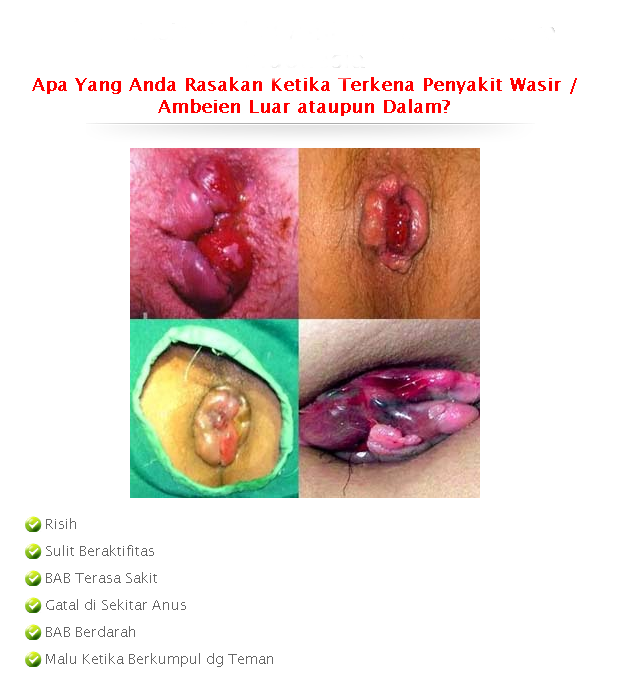 Obat Wasir Di Seluma Barat,Obat Ambeien di Palu Barat,Obat Ambeien Wasir DI Negaradaha,Cara Mengobati Wasir Di Simongagrok,Cara Menghilangkan Wasir DI Tunjungmekar,Obat Wasir Ampuh Di  Sentolo,Obat Wasir Tanpa Operasi Di  Rote Selatan,Obat Wasir Berdarah Di Normal I,Obat Penyakit Wasir Di Kab. Tuban