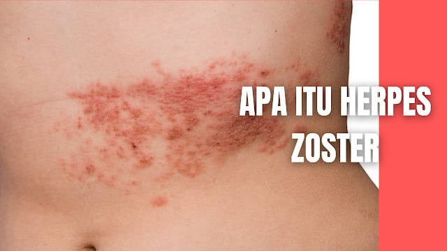 Apa Itu Herpes Zoster Pada Manusia Herpes zoster disebabkan oleh reaktivasi varicella zoster virus (VZV) laten dari saraf tepi dan saraf pusat. varicella zoster virus merupakan patogen utama terhadap dua infeksi klinis utama pada manusia yaitu varicella atau chickenpox (cacar air) dan herpes zoster (cacar ular). Varicella merupakan infeksi primer yang terjadi pada individu yang terpapar dengan varicella zoster virus. Pada 3-5 dari 1000 individu, varicella zoster virus mengalami reaktivasi, menyebabkan infeksi reaktivasi yang dikenal dengan nama Herpes zoster atau Shingles. (Amnil A., 2010)  Herpes zoster adalah infeksi virus akut yang memiliki karakteristik unilateral, sebelum timbul manifestasi klinis pada kulit wajah dan mukosa mulut biasanya akan didahului oleh gejala odontalgia. Timbulnya gejala odontalgia pada Herpes zoster belum sepenuhnya diketahui (Harpaz R., dkk, 2009).    Nah itu dia bahasan dari apa itu herpes zoster pada manusia, melalui bahasan di atas bisa diketahui mengenai apa itu herpes zoster pada manusia. Mungkin hanya itu yang bisa disampaikan di dalam artikel ini, mohon maaf bila terjadi kesalahan di dalam penulisan, dan terimakasih telah membaca artikel ini."God Bless and Protect Us"