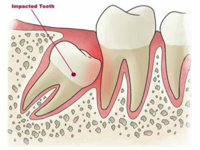  Răng khôn mọc thẳng gây đau nhức