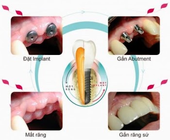 trồng răng implant ở đâu uy tín