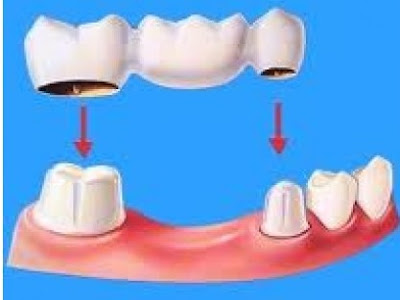 Những loại răng sứ trong phục hình răng cố định