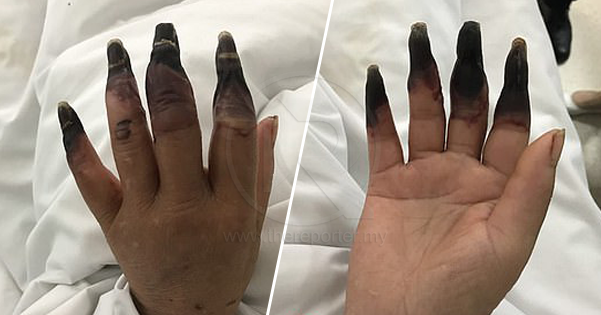 Surirumah terkejut 8 jarinya bertukar hitam selepas 