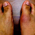 Most Effective Home Remedies for Gout