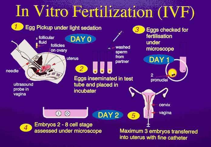 In Vitro Fertilization (IVF)