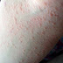 Why you need to know about Urticaria?