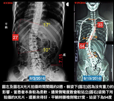 脊椎側彎度數測量, 脊椎側彎, 脊椎側彎評估, 脊椎側彎度數比較