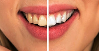  اتّبع روتين أساسي للعناية بالأسنان