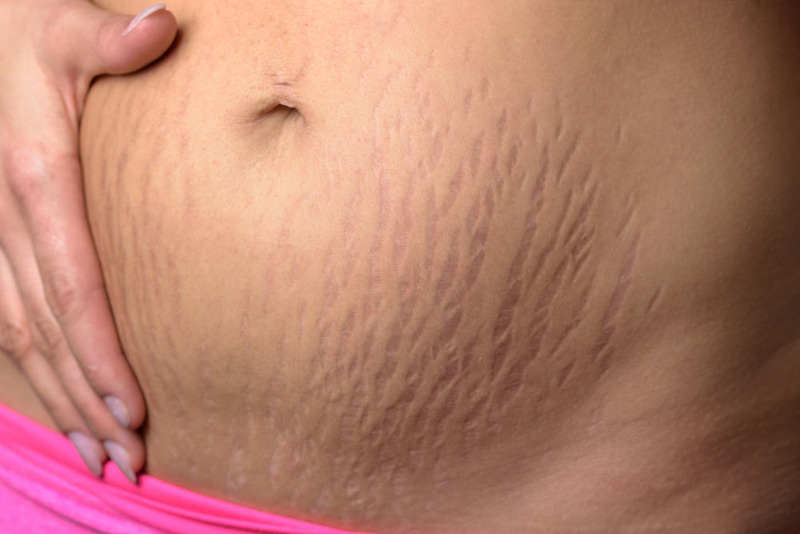 Natural Remedies for Stretch Marks