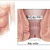 Nứt kẽ hậu môn: Nguyên nhân và cách điều trị