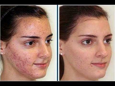 how to get rid of acne fast with home remedies