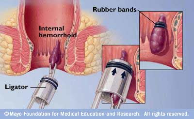 Klinik Mansurah: BUASIR (HEMORRHOID)